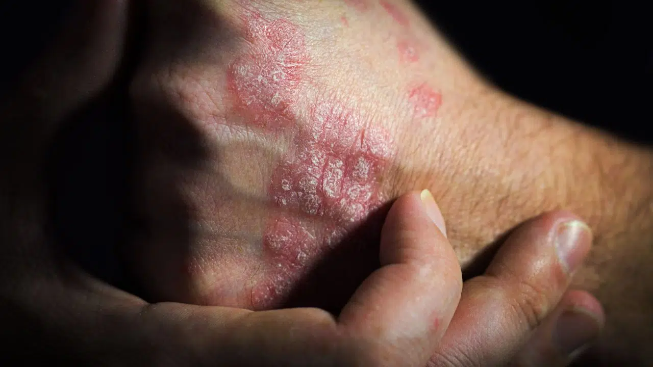 Doenças autoimunes: quando o corpo ataca a si mesmo