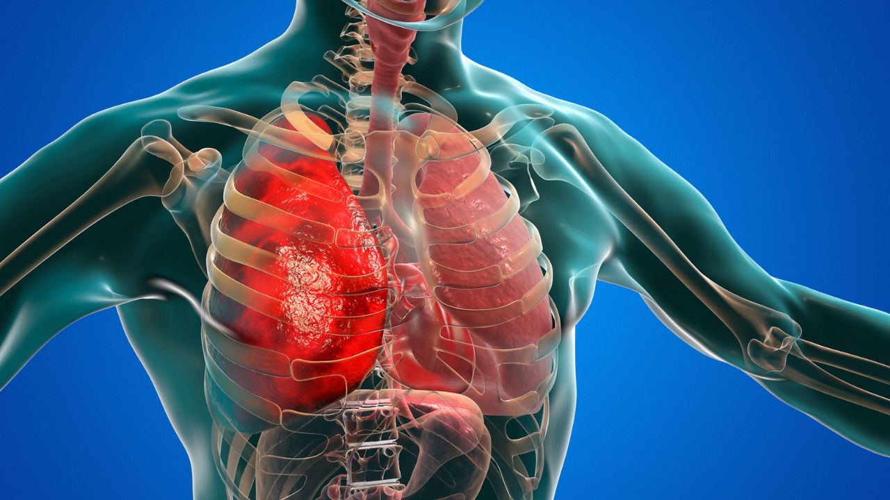 Simpatia para curar bronquite