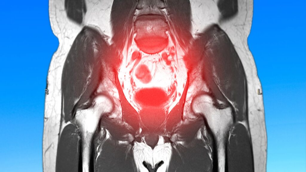 Miomas: o chamado do corpo para resgatar sua essência