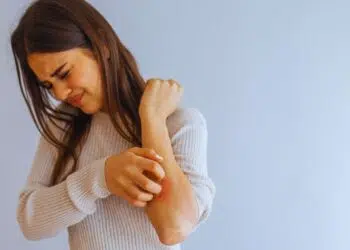 Psoríase e emoções: como a raiva e a vergonha afetam sua pele