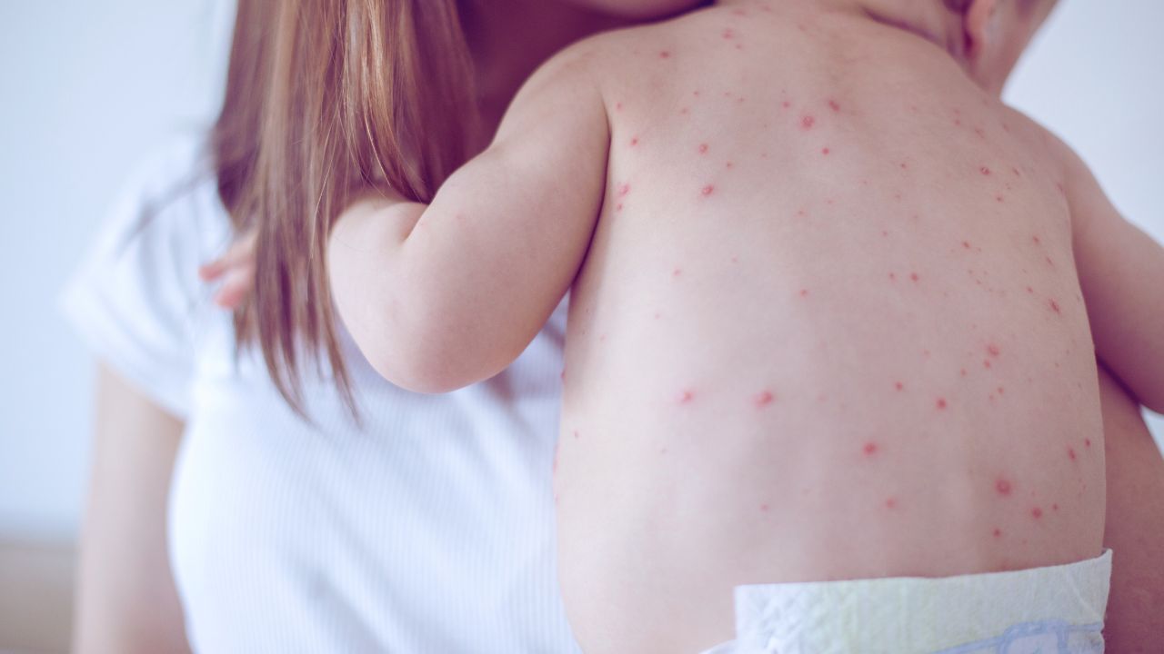 Casos de sarampo cresceram 34 vezes nas Américas em 2025, alerta Opas. Vacinação é essencial para conter a doença altamente contagiosa.