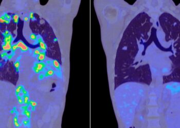Brasil deve ter 781 mil novos casos de câncer por ano até 2028, alerta Inca