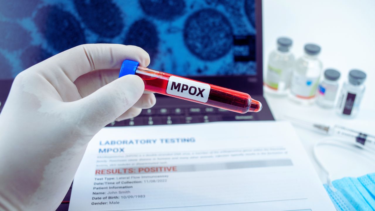 Brasil confirma 88 casos de Mpox em 2026 e expõe contraste nos dados de São Paulo